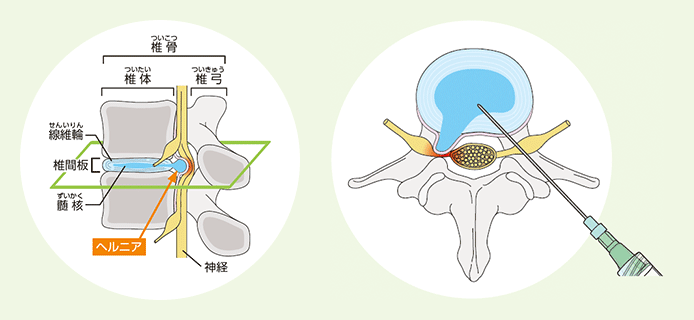 ヘルニコアイメージ図